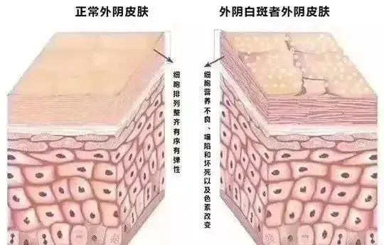 患上外阴白斑后的危害有哪些？