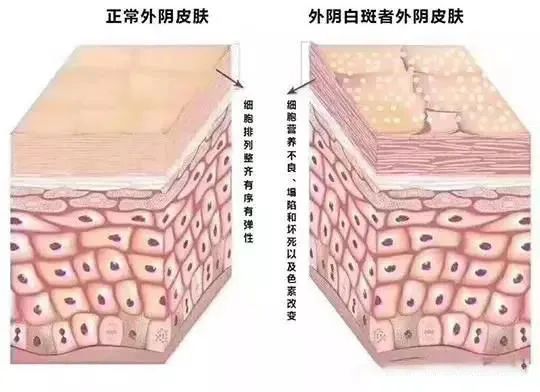 轻度外阴白斑只擦药能治愈吗？