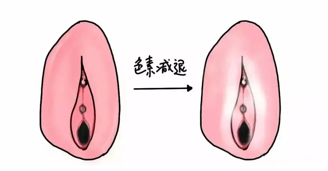 外阴白斑和白癜风有什么区别？