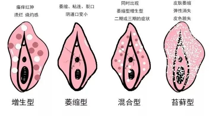 外阴白斑与外阴湿疹有什么不同？