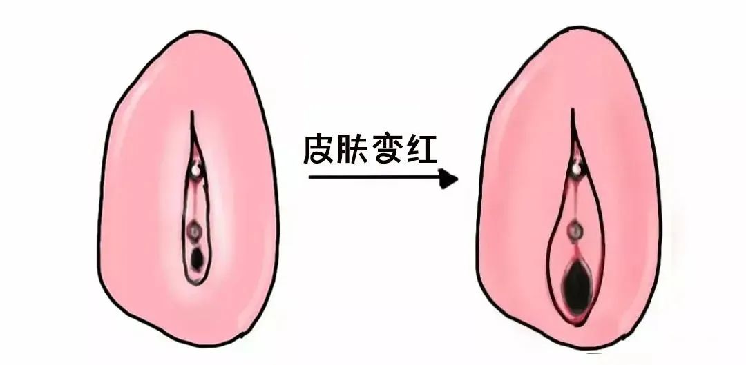 外阴白斑好转的迹象有哪些？