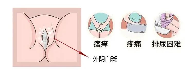 混合型外阴白斑的病因和危害都有哪些？