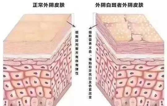 得了外阴白斑二十几年还能治疗好吗？