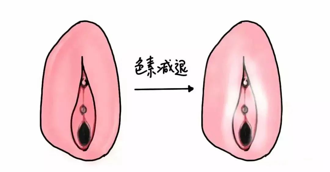 外阴白斑初期四种最明显的症状