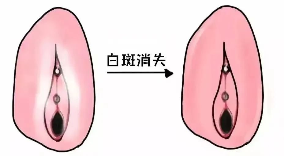 外阴白斑患者如何快速复色？