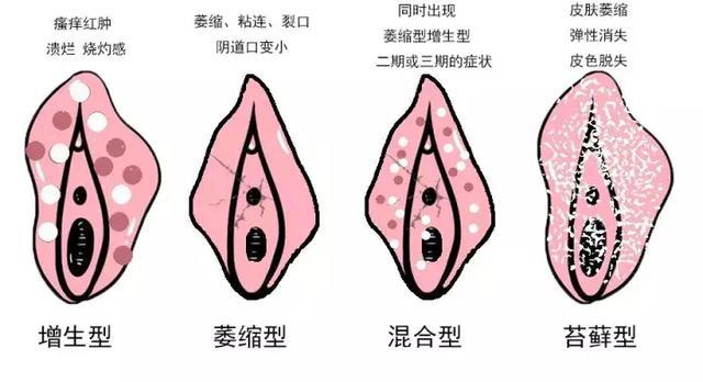 外阴白斑所引起的哪些危害影响比较大？