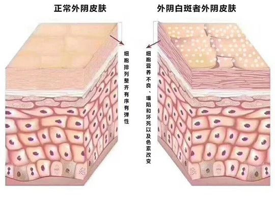 外阴白斑好转的迹象都有哪些？