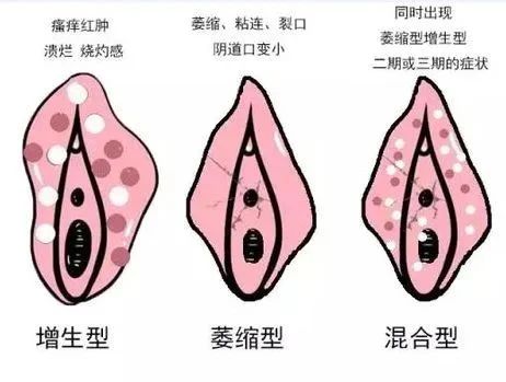 外阴出现瘙痒是外阴湿疹还是外阴白斑？