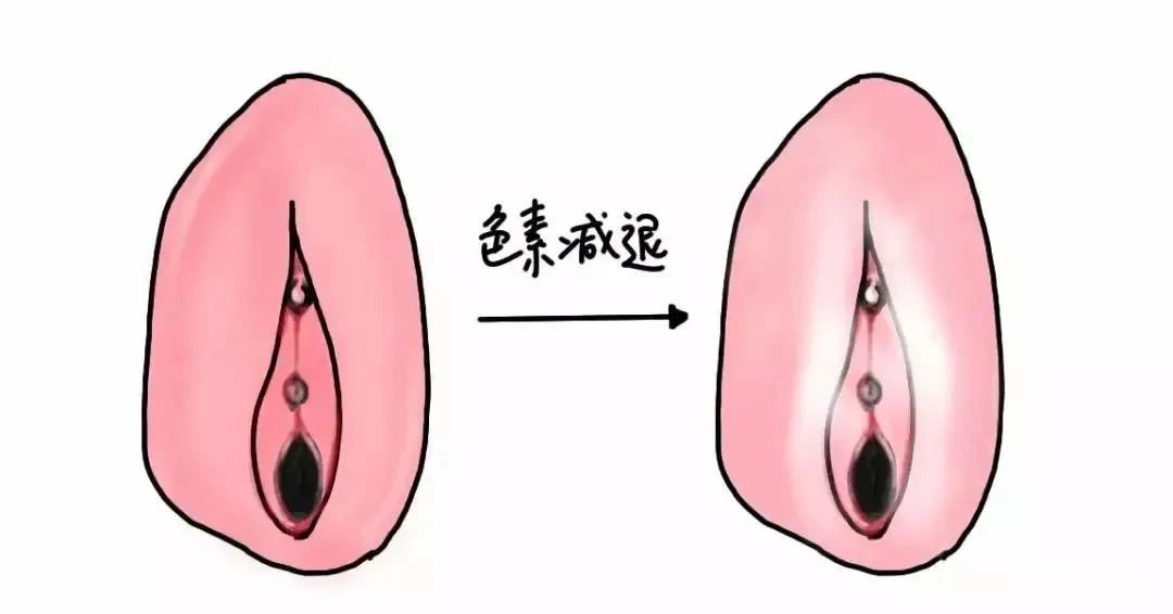 外阴营养不良是什么原因造成的？