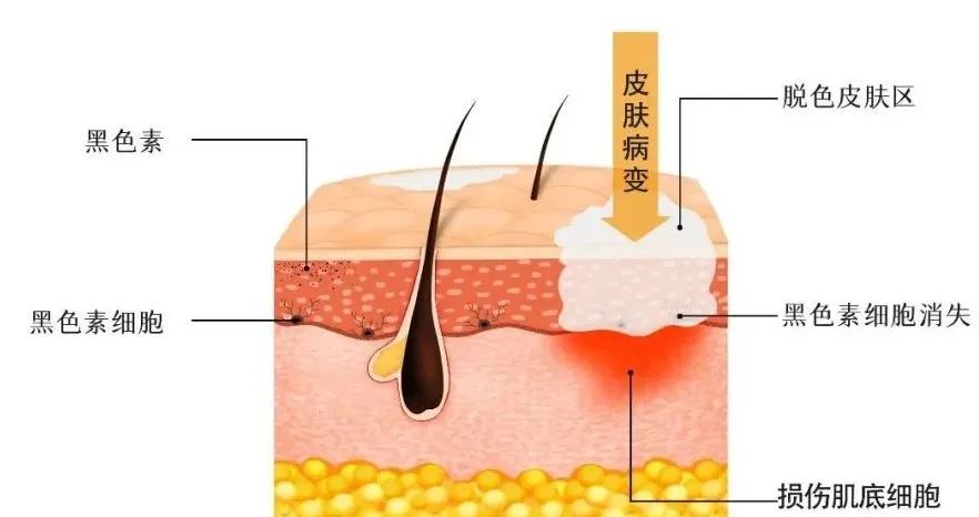 什么叫做外阴白斑? 什么叫做外阴白斑?