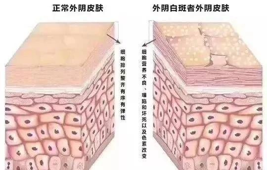 在确诊外阴白斑症状较轻会自己好起来吗？