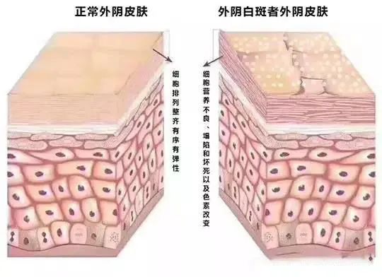 红光能治疗外阴白斑吗