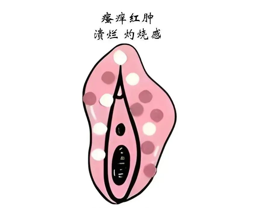 外阴白斑治疗时间周期是受哪些因素影响的? 外阴白斑治疗时间周期是受哪些因素影响的?