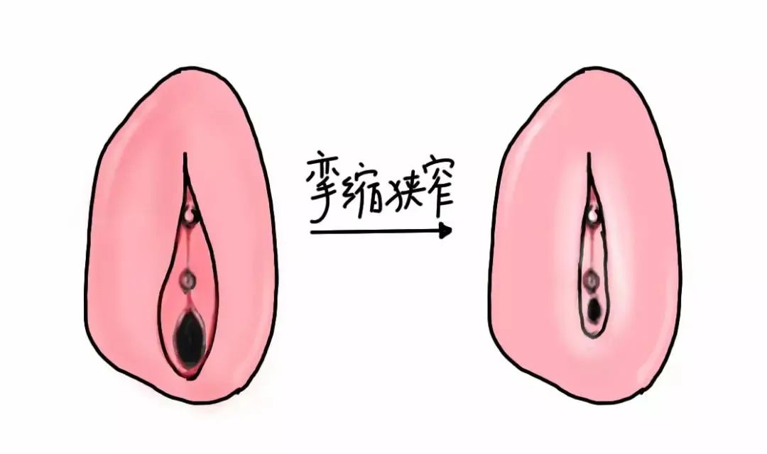 外阴白斑治愈的标准