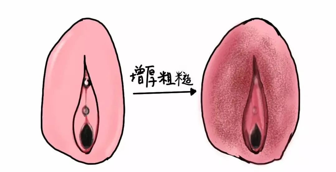 外阴白斑疾病怎么自测
