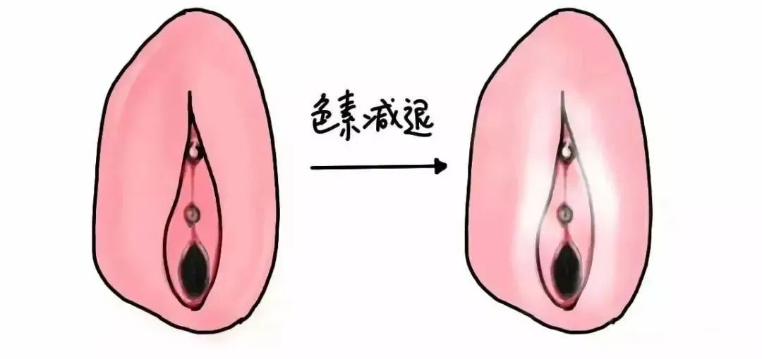 患上外阴白斑是什么颜色